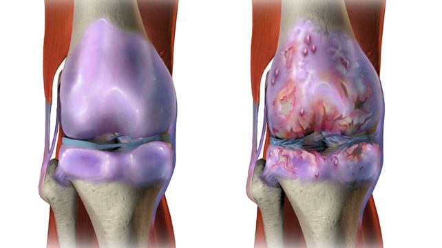 Cartilage Regeneration